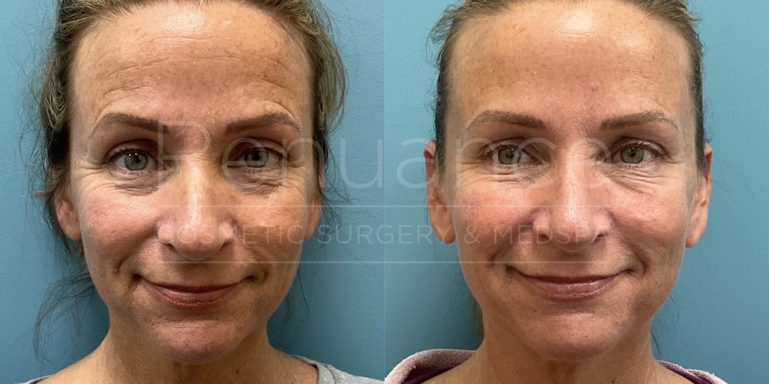 Renuance - Sculptra and Botox before and after photo