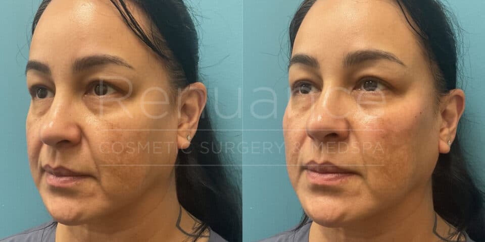 Renuance - Voluma before and after photo - Angle 1