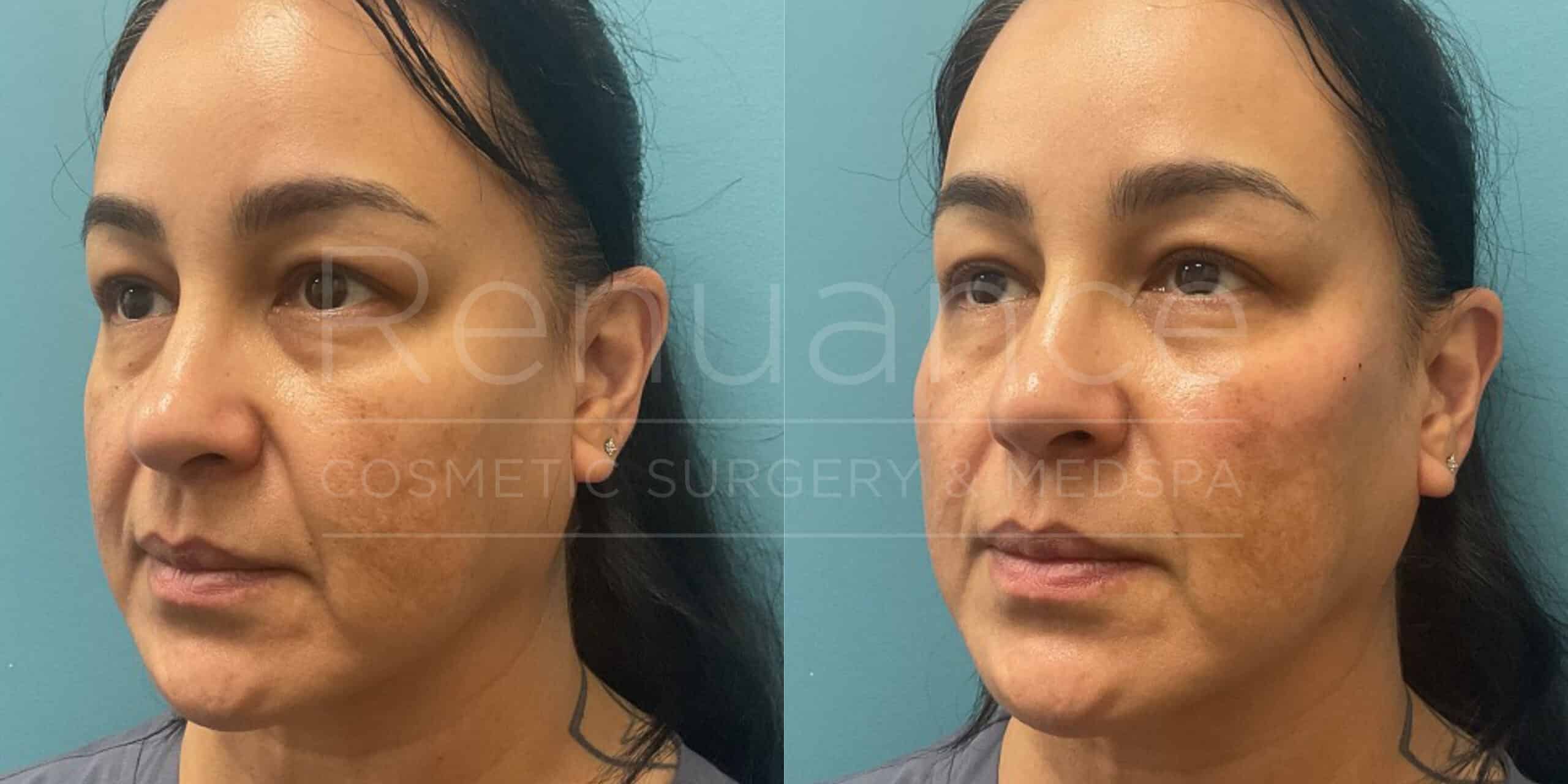 Renuance - Voluma before and after photo - Angle 1