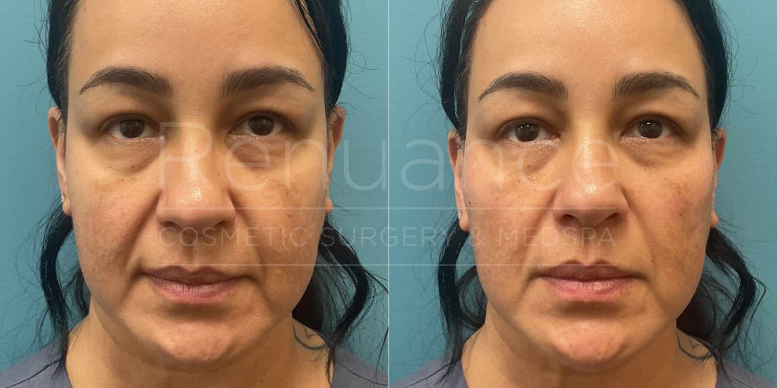 Renuance - Voluma before and after photo - Angle 2