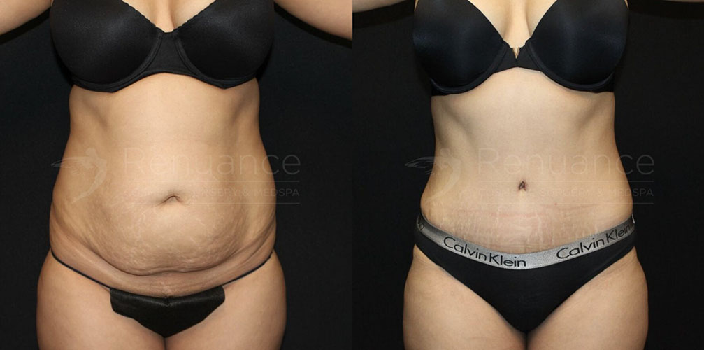 Abdominoplasty (Tummy tuck)