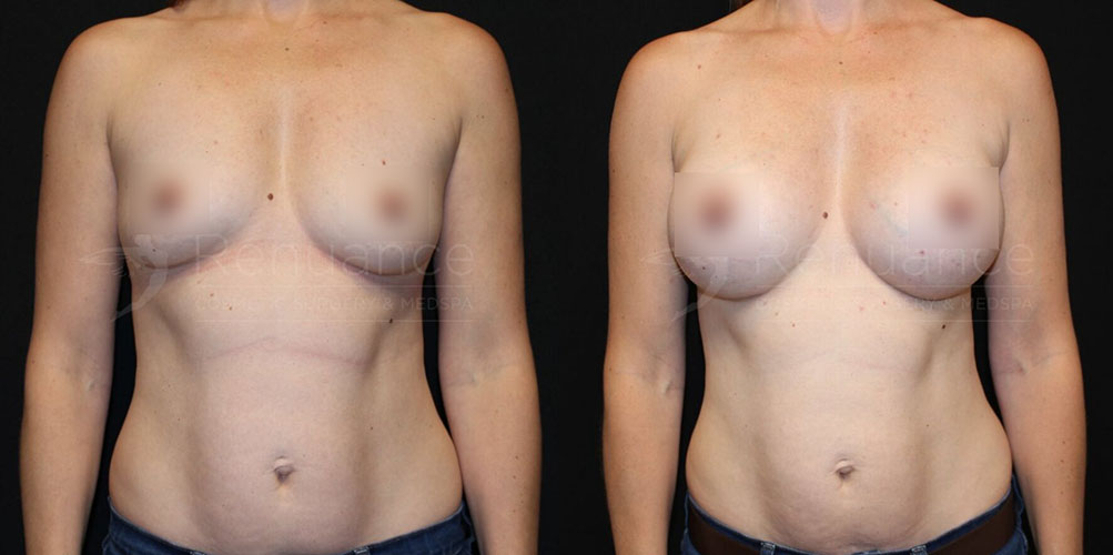 Breast augmentation