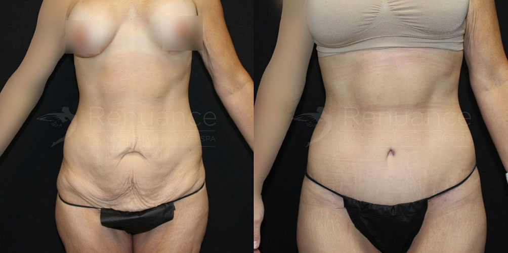 Abdominoplasty (Tummy tuck)
