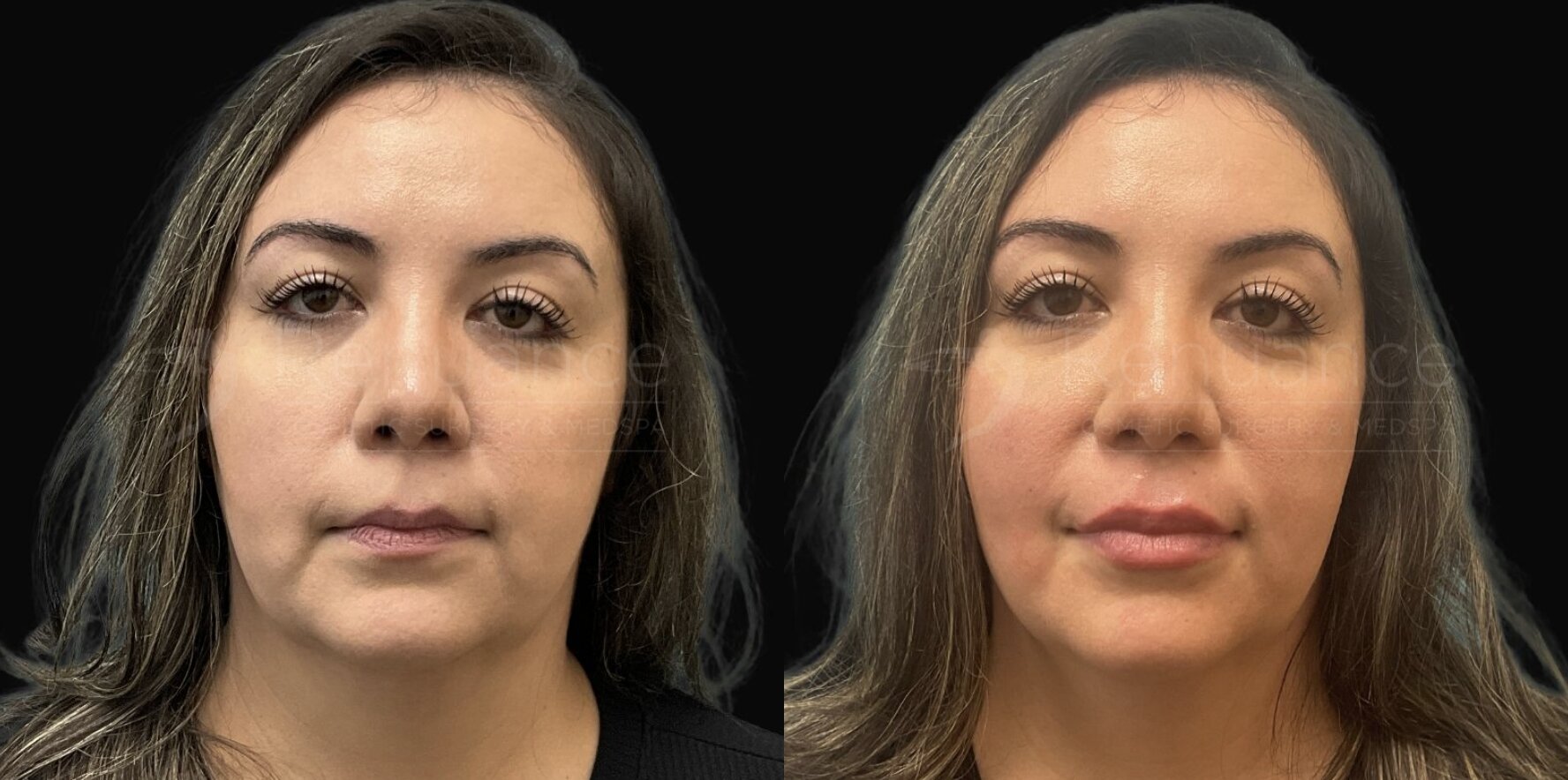 Lip Filler with Juvederm Ultra Plus