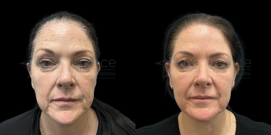 Before and After CO2 Laser by Dr. Debbie