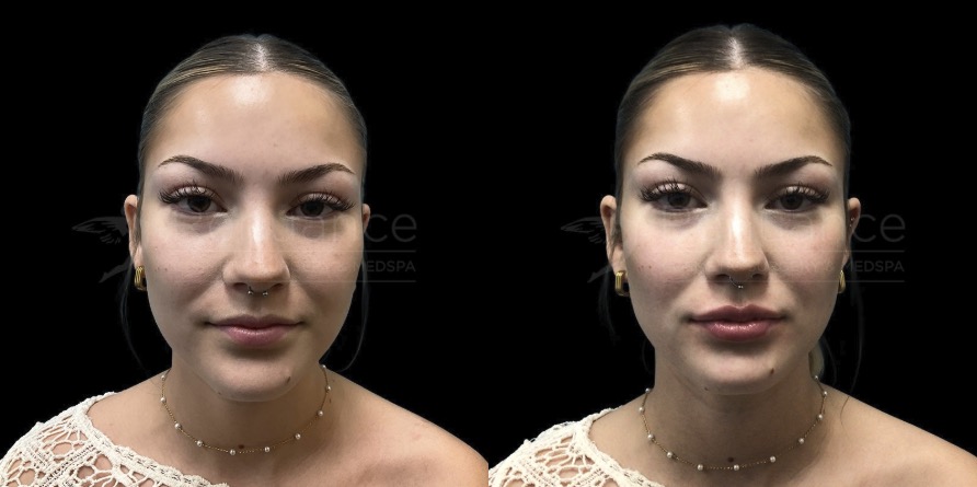 Before and After Lip Lift by Dr. Debbie