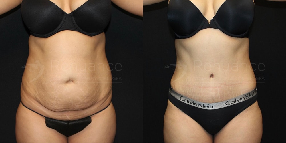 before and after tummy tuck patient | Dr. Rachel Ford