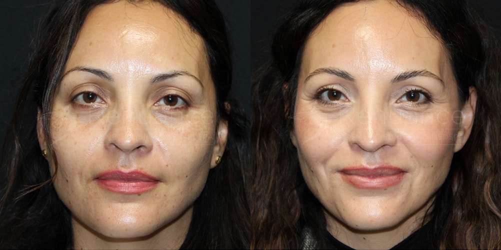 before and after blepharoplasty eyelid surgery patient | Dr. Rachel Ford