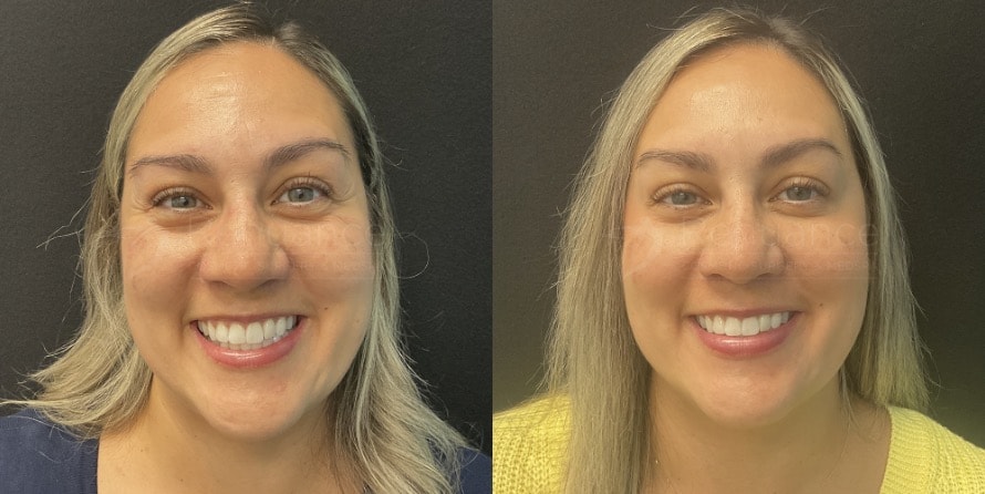 Before and After BOTOX by Chelsea 1