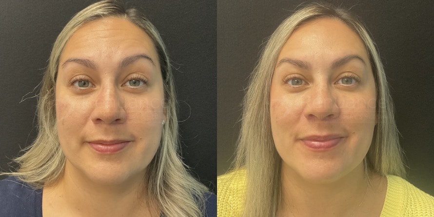 Before and After BOTOX by Chelsea 3