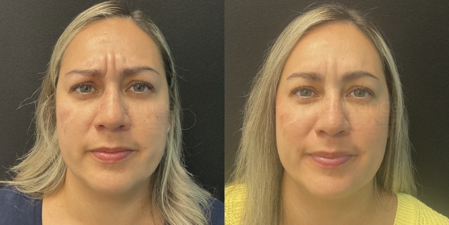 Before and After BOTOX by Chelsea 2