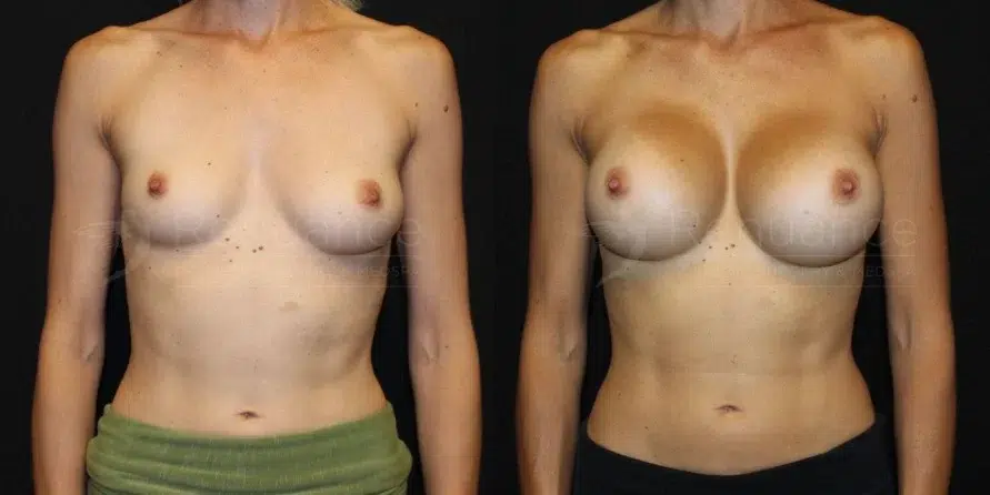 Breast Augmentation Before and After 03 - Renuance