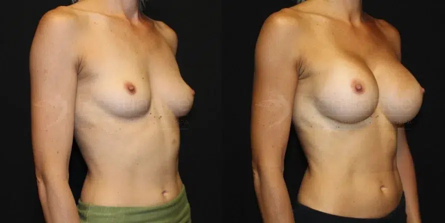 Breast Augmentation Before and After 04 - Renuance