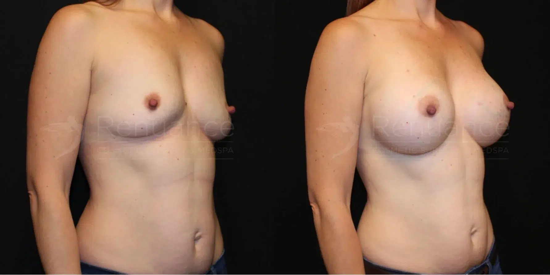 Breast Augmentation Before and After 10 - Renuance
