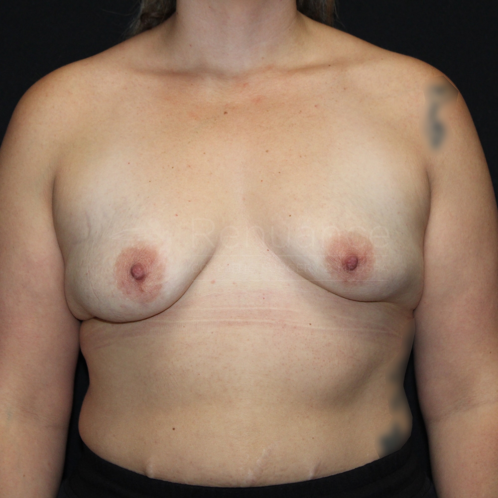 Case--7488 | Before Breast Augmentation