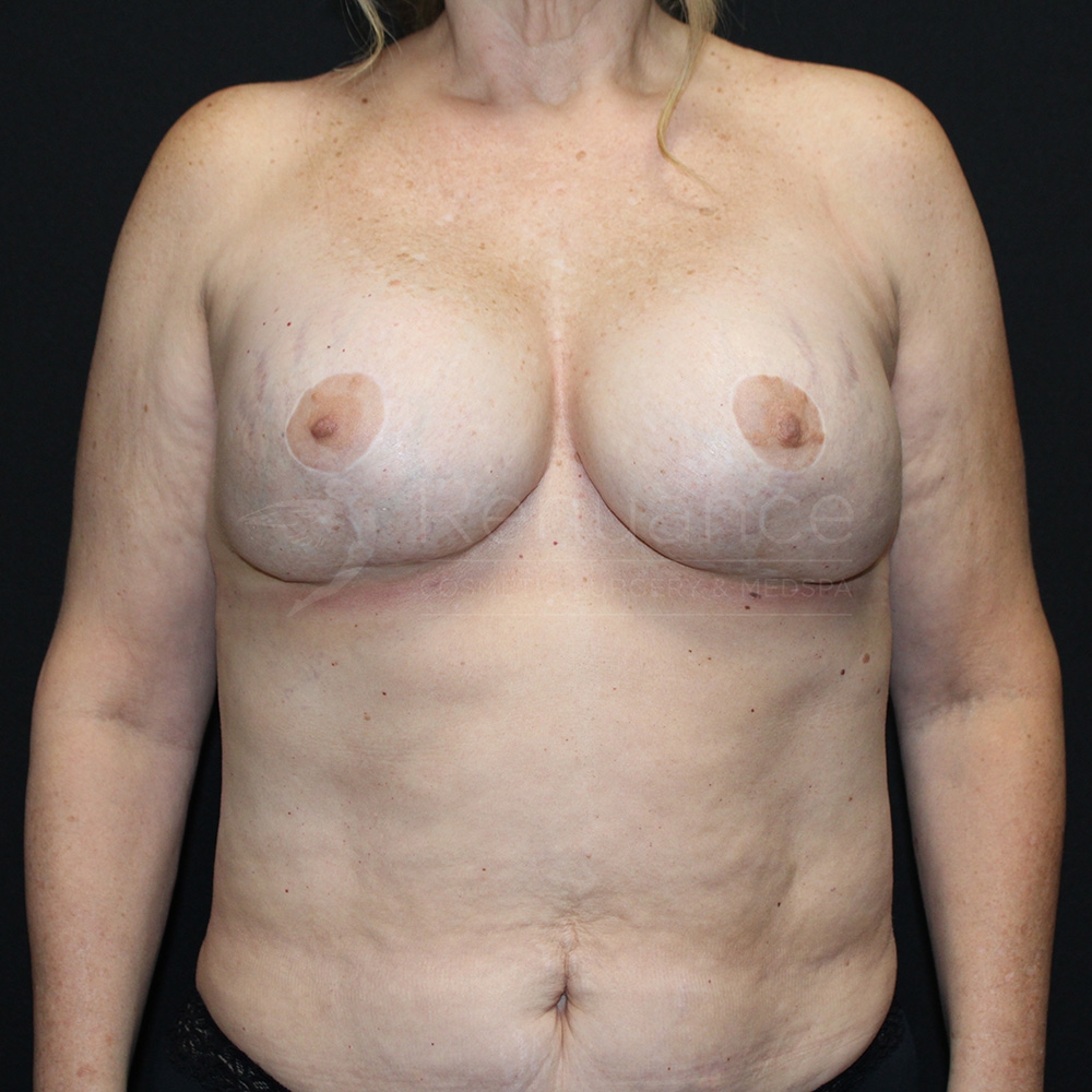 Case--3710P10 | After Breast Implant Exchange