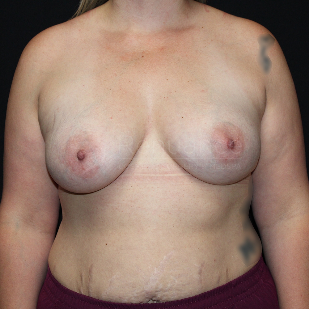 Case--7488 | After Breast Augmentation