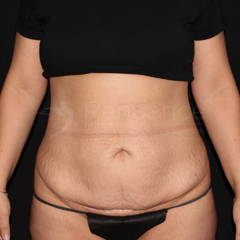 Case--1829 | Before Tummy Tuck