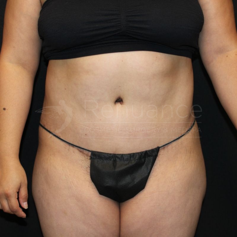 Case--1959 | After Tummy Tuck