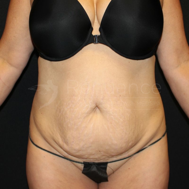 Case--3286 | Before Tummy Tuck