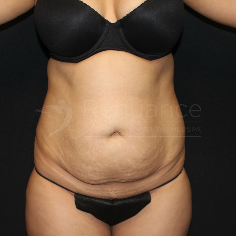 Case--5575 | Before Tummy Tuck