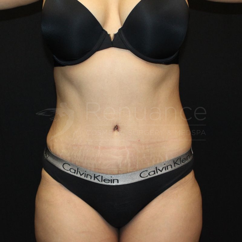 Case--5575 | After Tummy Tuck