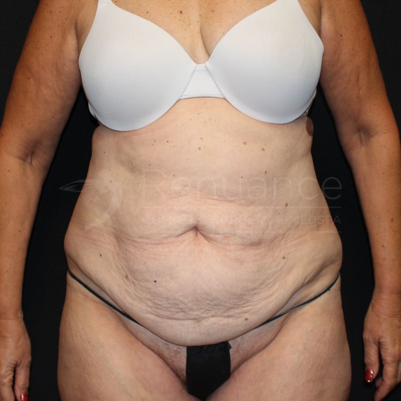 Case--9784 | Before Tummy Tuck