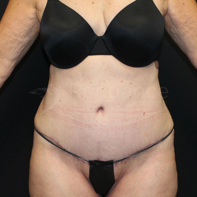 Case--9784 | After Tummy Tuck
