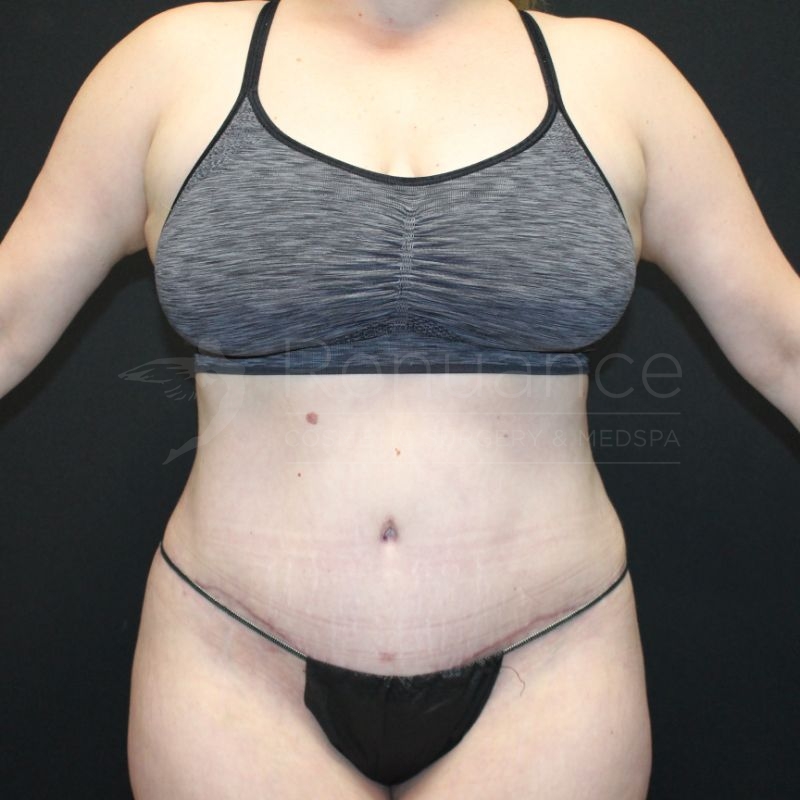 Case--2032 | After Tummy Tuck