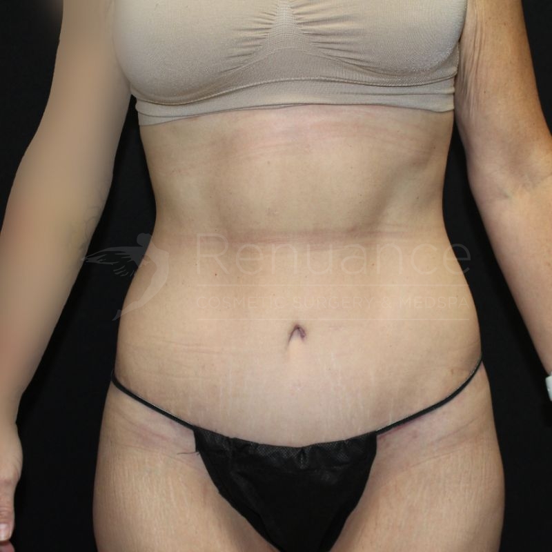 Case--5163 | After Rachel S. Ford, MD