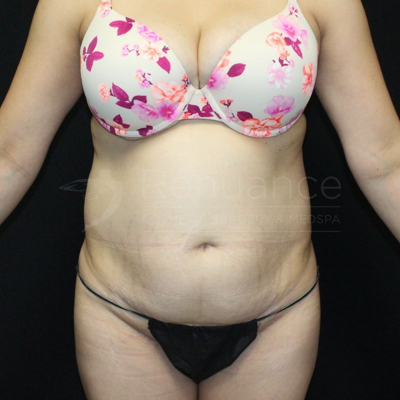 Case--2636 | Before Tummy Tuck