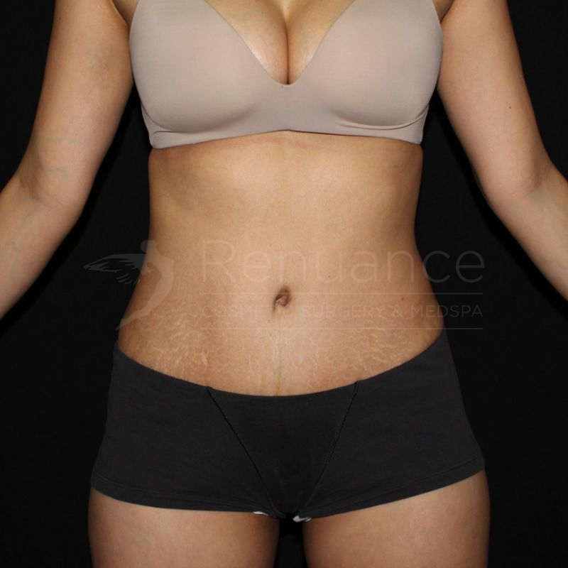 Case--8919 | After Tummy Tuck
