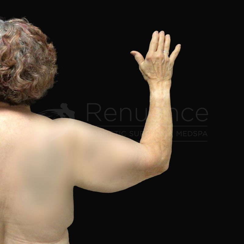 Case--9330H1a | Before Liposuction