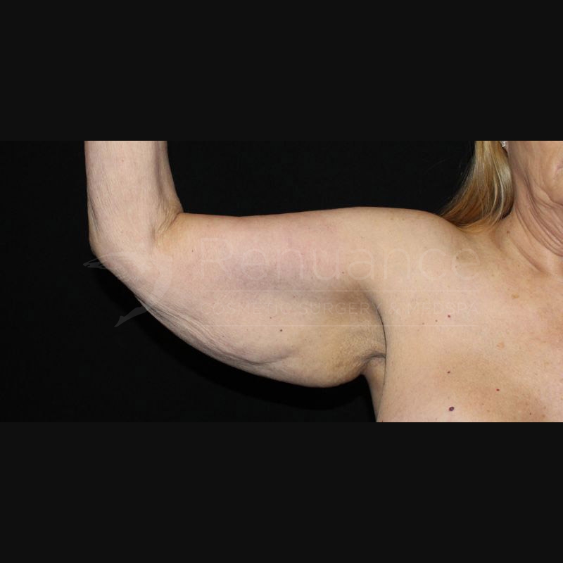 Case--5039 | Before Brachioplasty