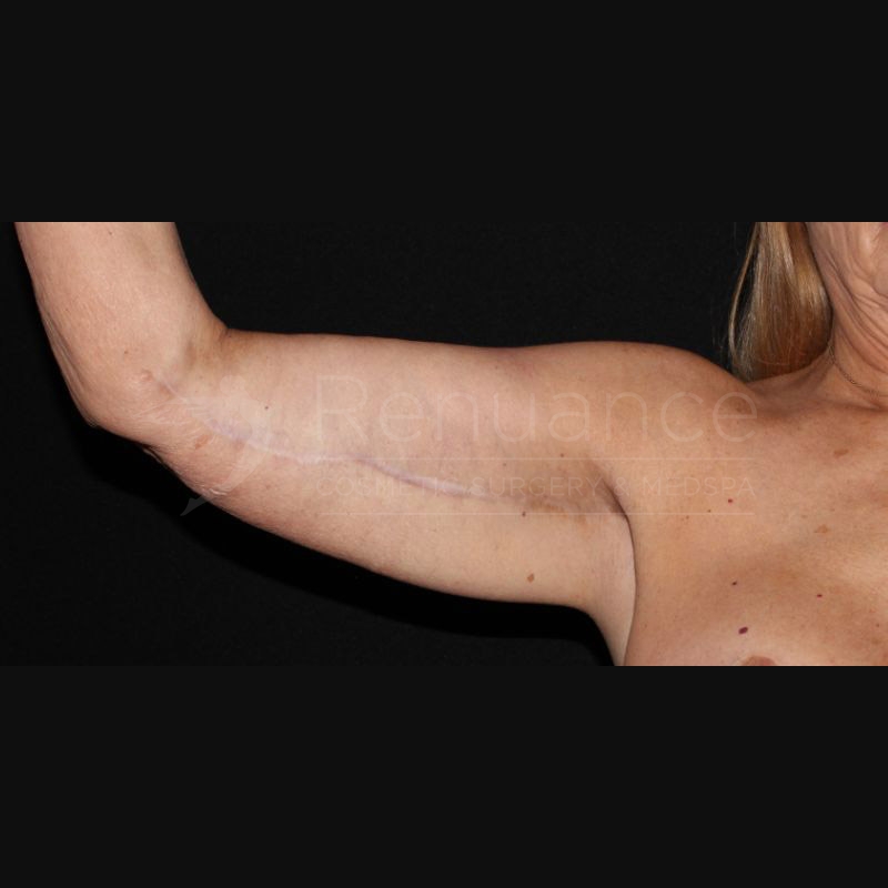 Case--5039 | After Brachioplasty