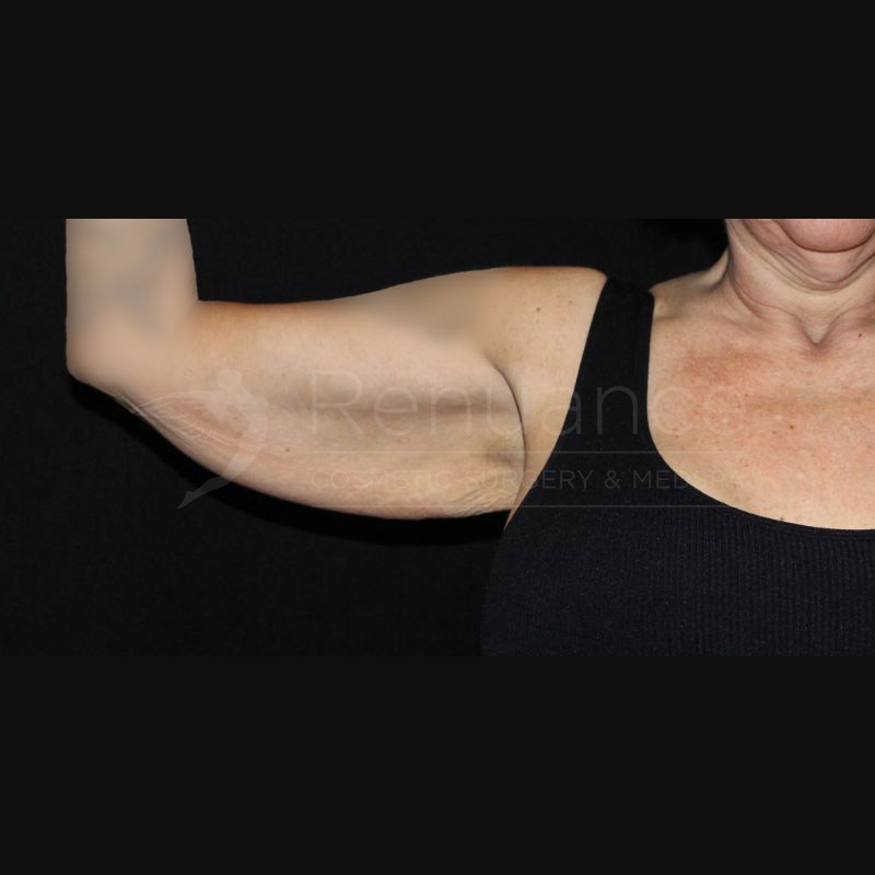 Case--1653 | Before Brachioplasty