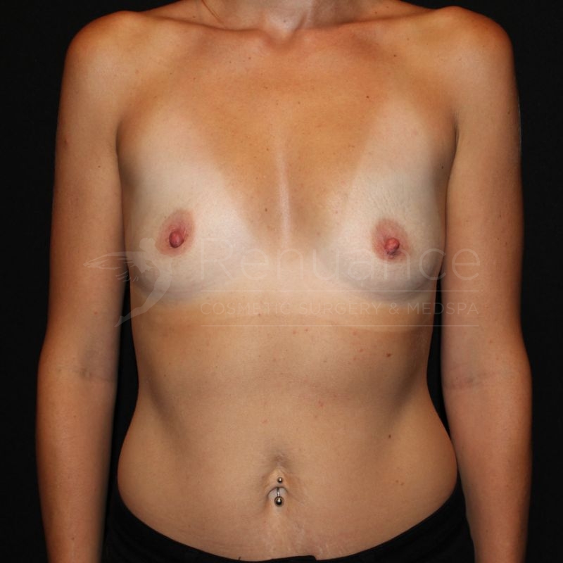 Case--3772P1 | Before Breast Augmentation