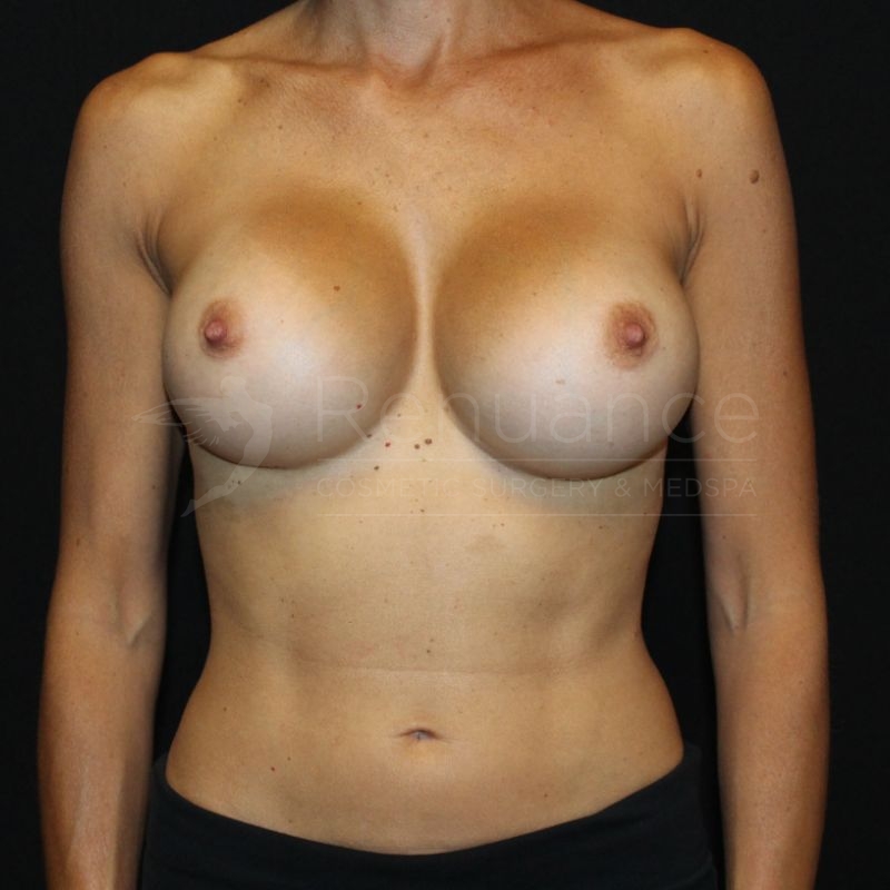 Case--9245P3 | After Breast Augmentation