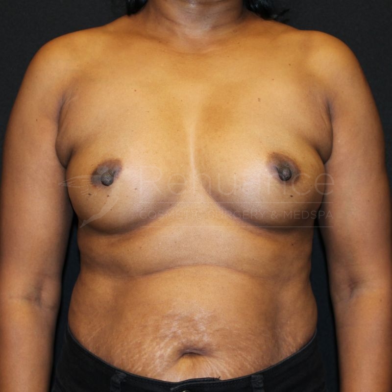 Case--5415P6 | Before Breast Augmentation