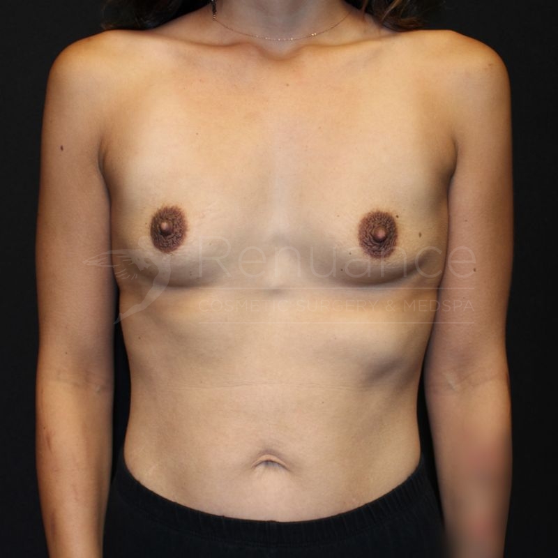 Case--4196P7 | Before Breast Augmentation
