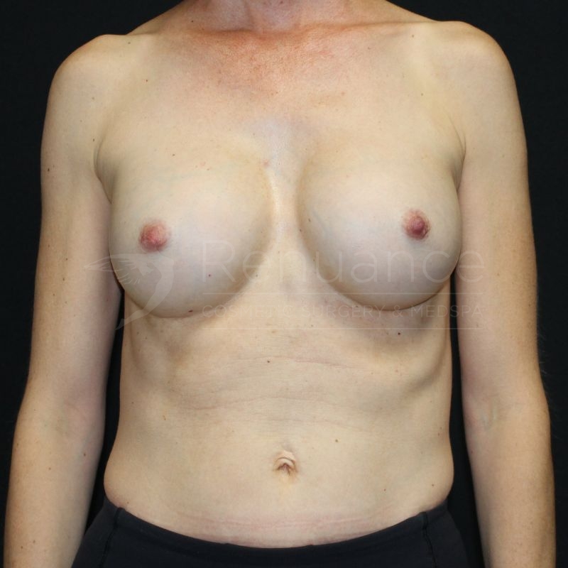 Case--3455P8 | After Breast Augmentation