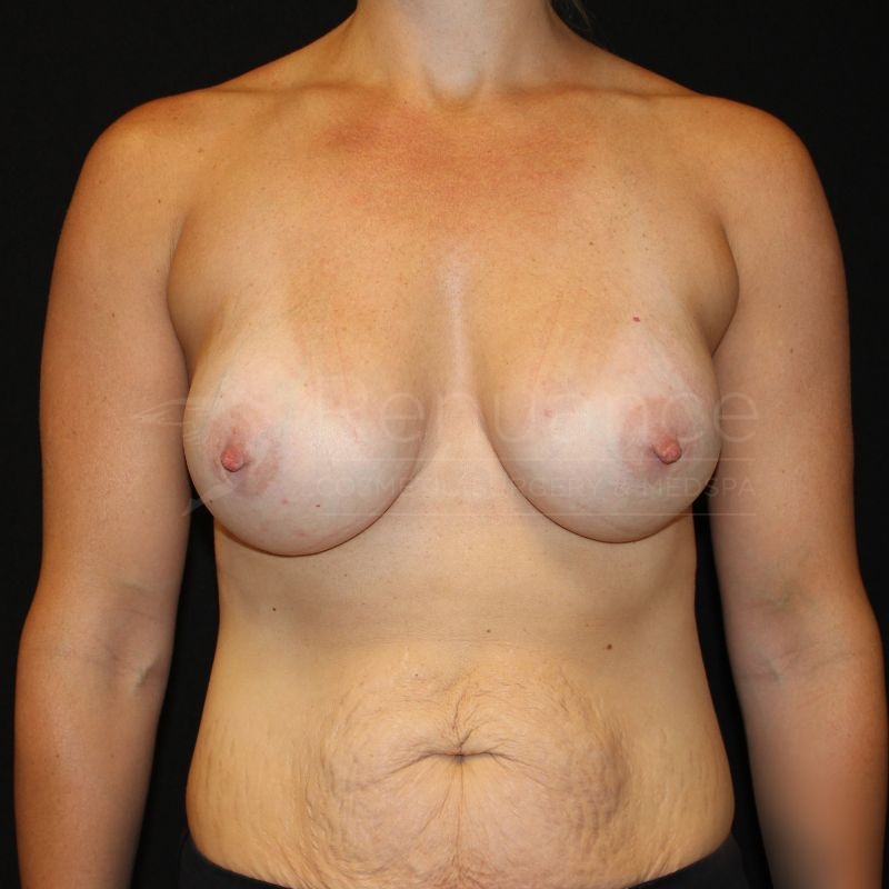 Case--5598P12 | After Breast Augmentation