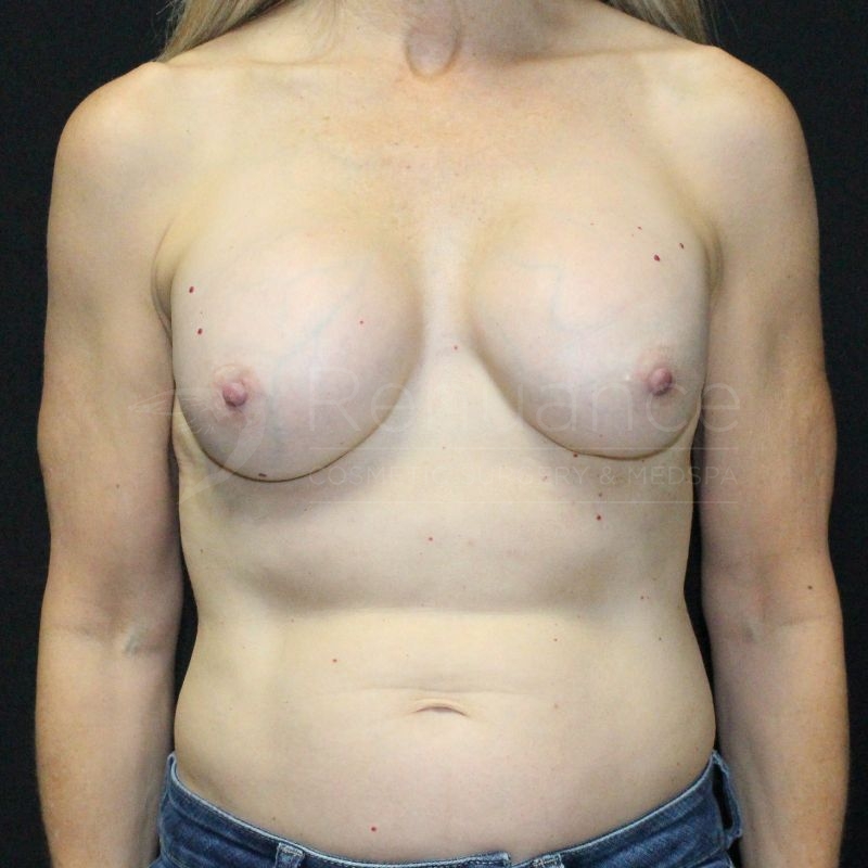Case--4780P14 | After Breast Augmentation