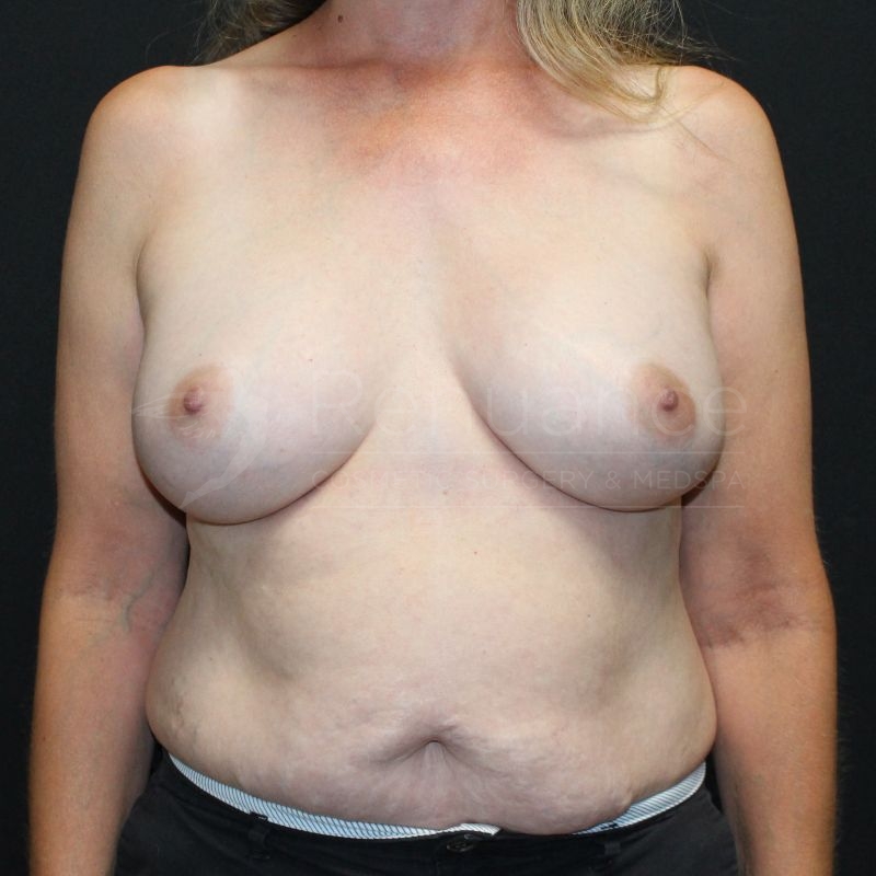 Case--5065P15 | After Breast Augmentation