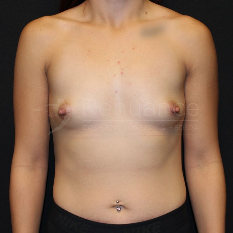Case--1215P18 | Before Breast Augmentation