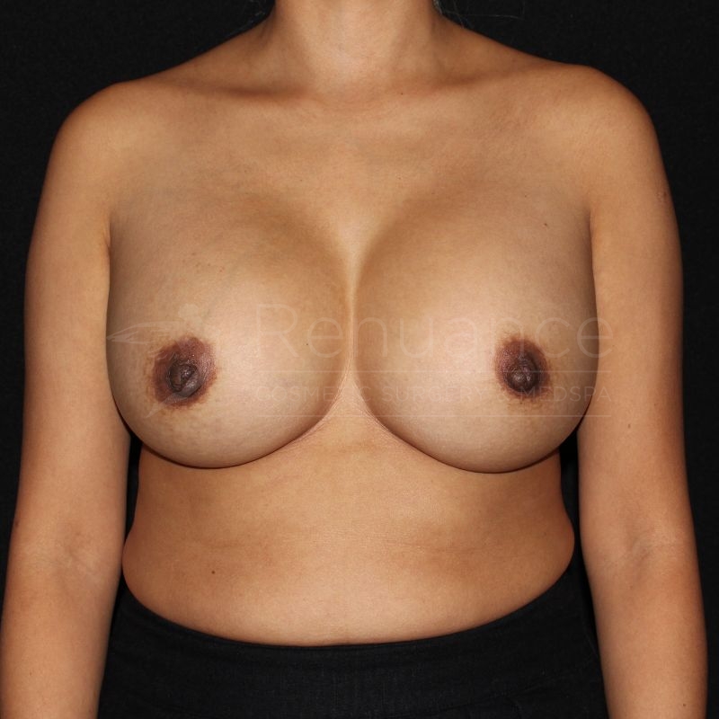 Case--3842P19 | After Breast Augmentation