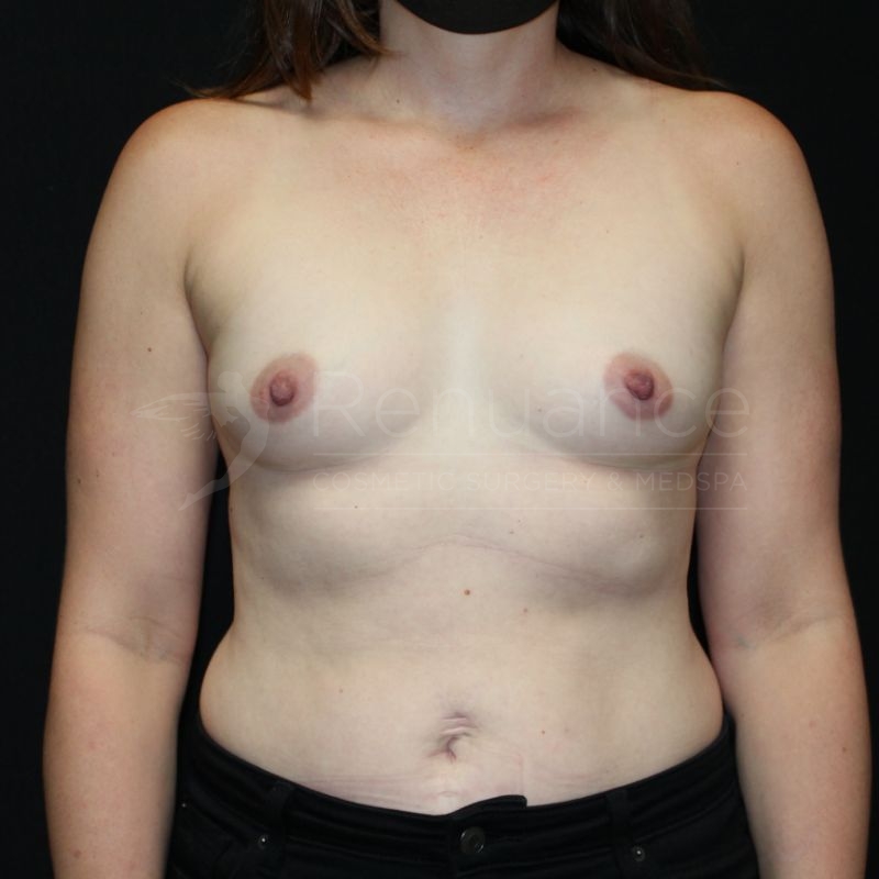 Case--9515P27 | Before Breast Augmentation