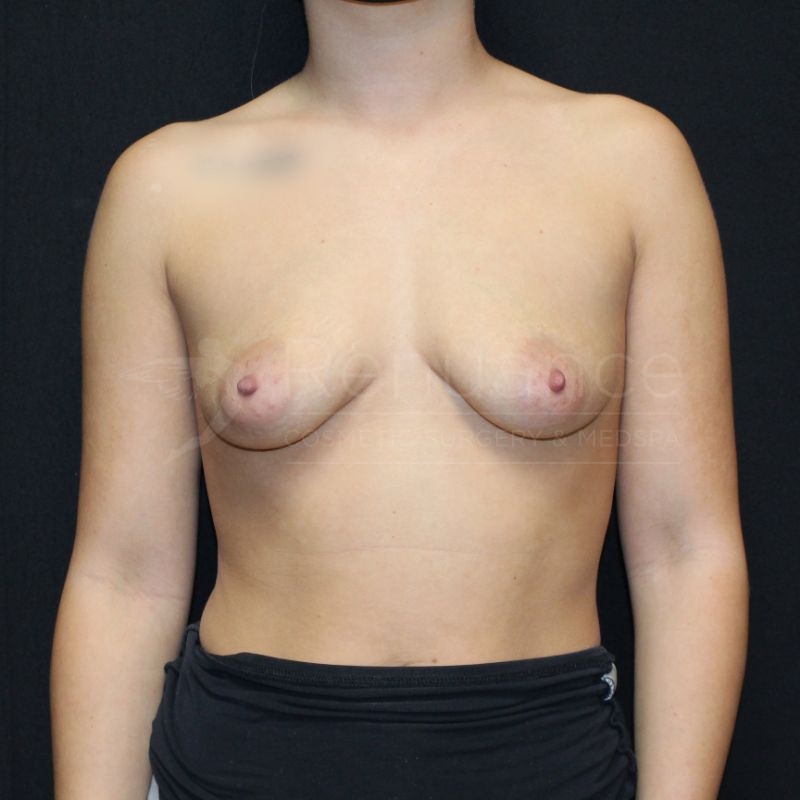 Case--1813P28 | Before Breast Augmentation