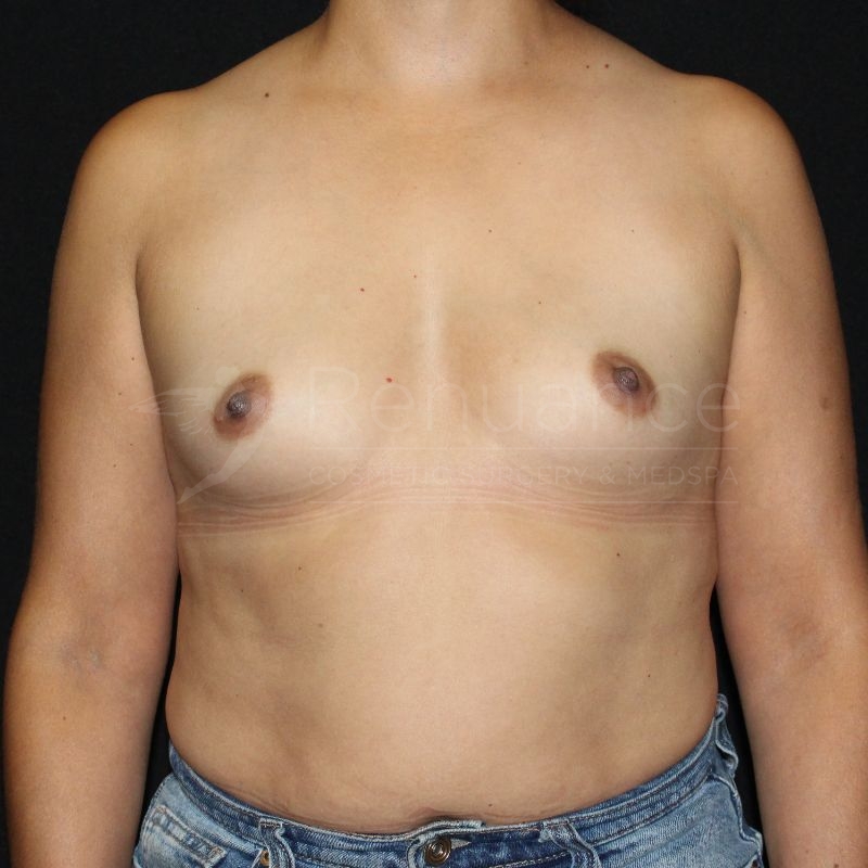 Case--8309P33 | Before Breast Augmentation