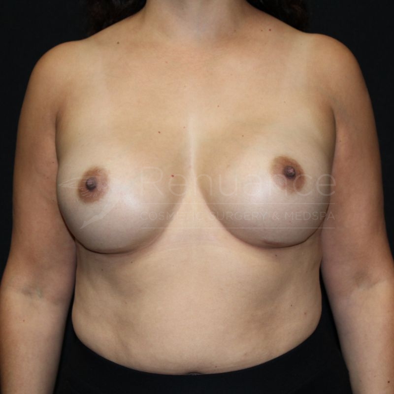Case--8309P33 | After Breast Augmentation